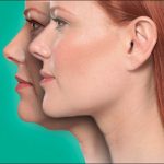 The Cost of AirSculpt Chin Surgery