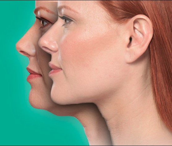 The Cost of AirSculpt Chin Surgery